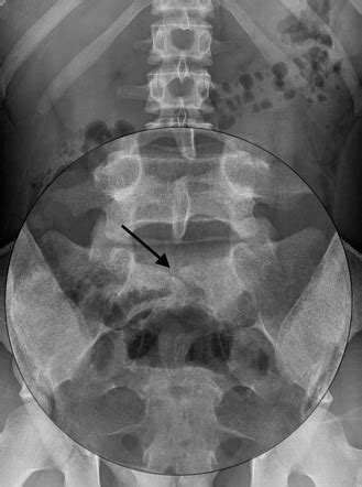 espina bifida oculta rx